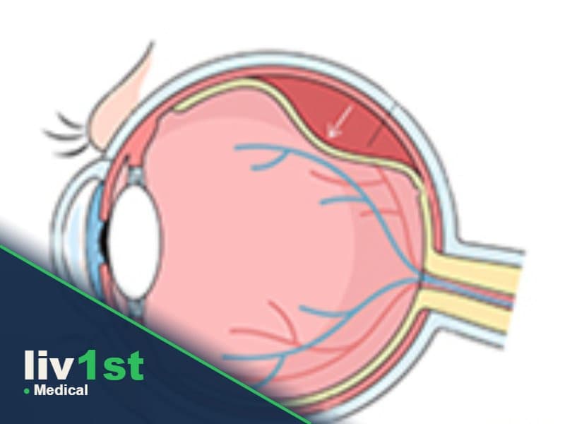 Macular Degeneration Surgery