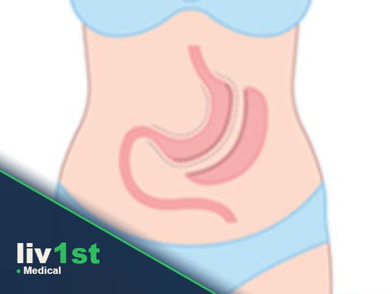 Sleeve Gastrectomy