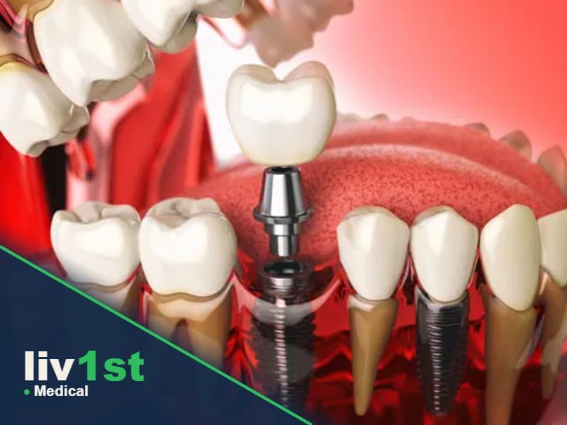 Dental Implants