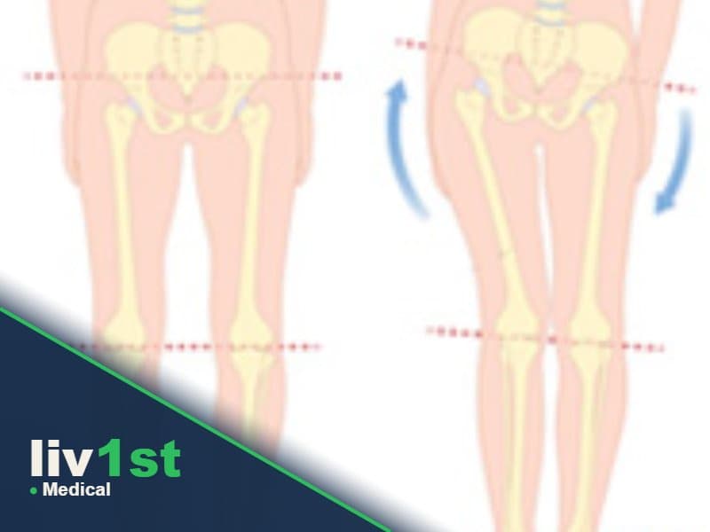 Cosmetic Limb Lengthening