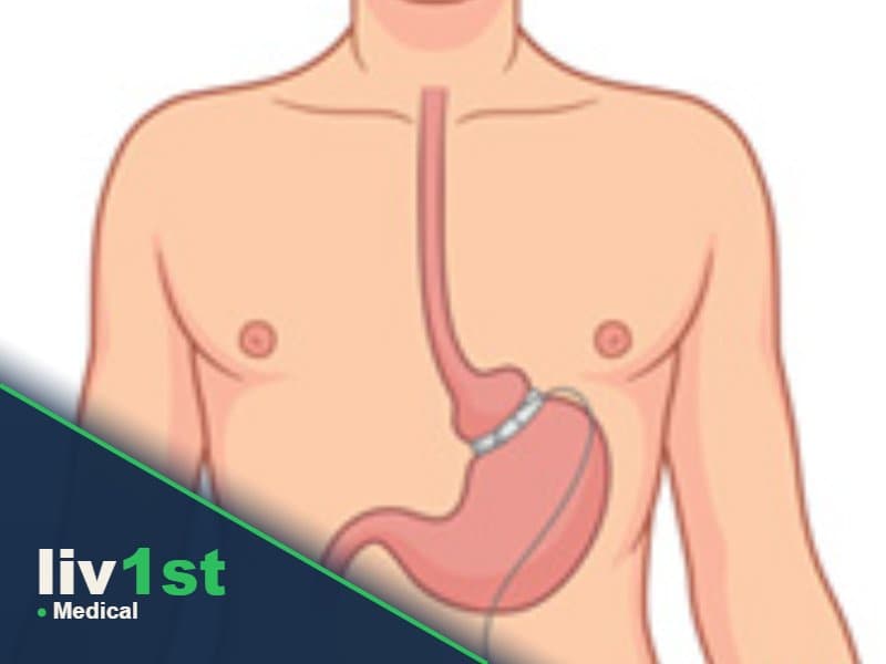 Laparoscopic Gastric Banding
