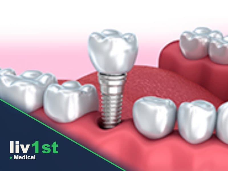 Dental Implants in Istanbul