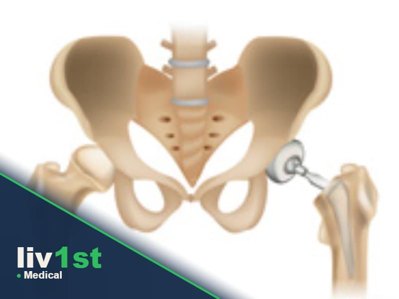 Hip Arthroplasty