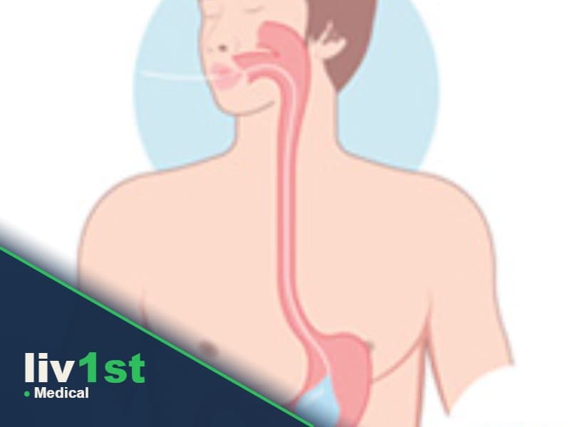 Gastric Pill Balloon