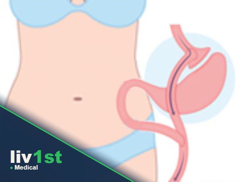 Gastric Bypass Surgery
