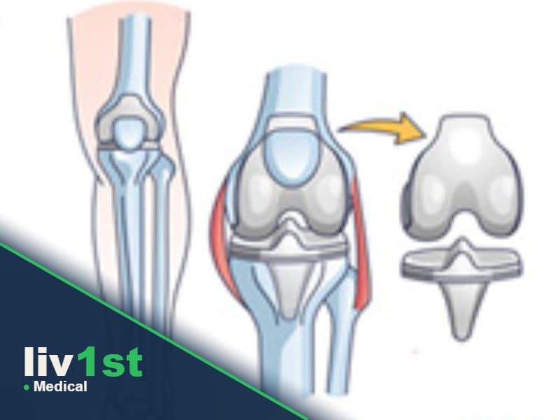 Knee Arthroscopy