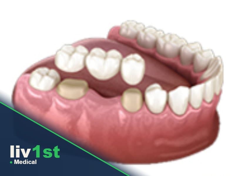 Dental Bridge