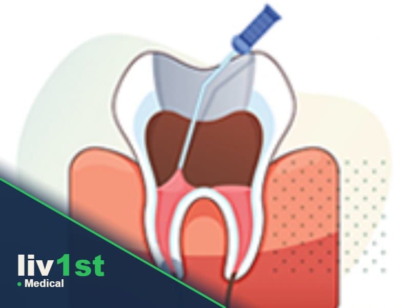 Root Canal Treatment