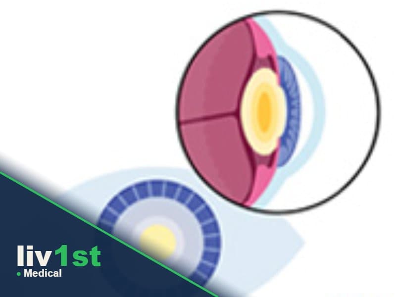 Cataract Surgery