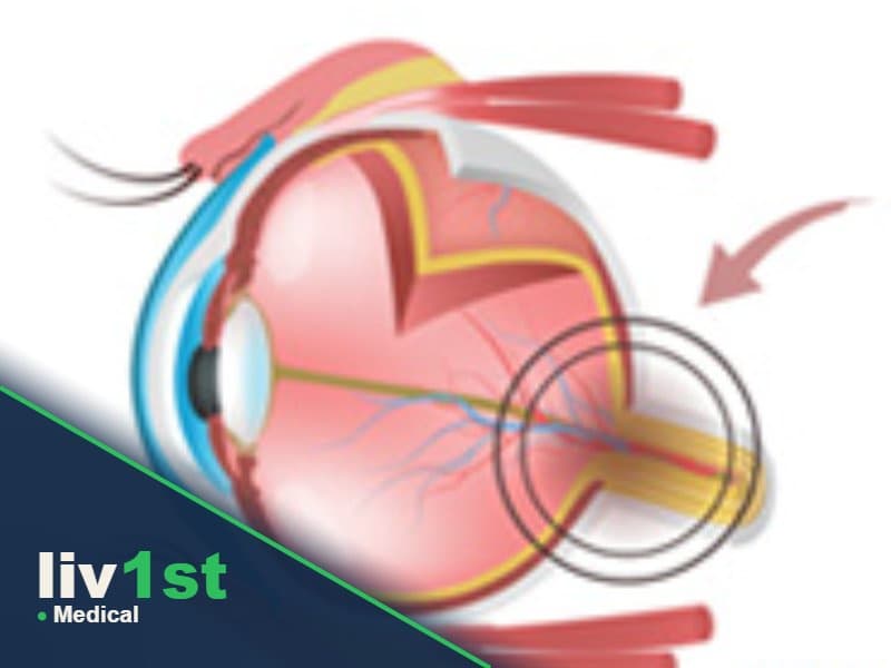 Glaucoma Surgery