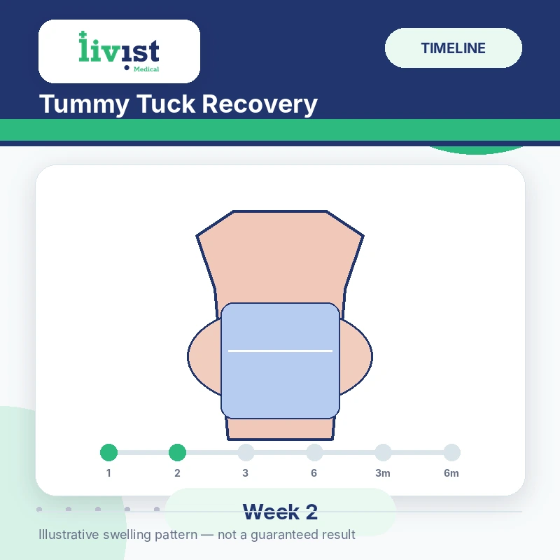 Tummy tuck recovery at week 2