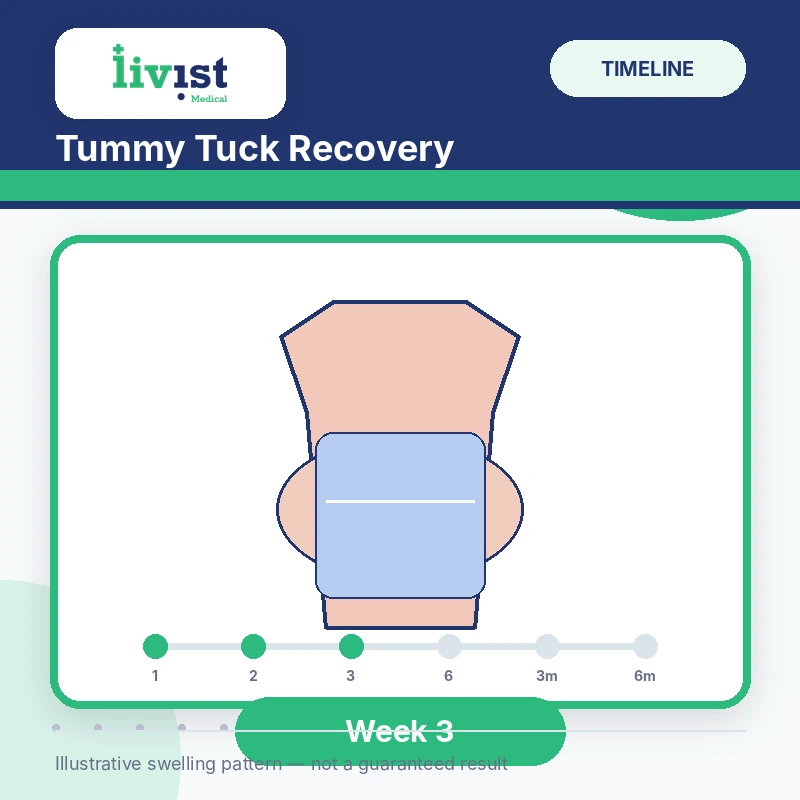Tummy tuck recovery at week 3