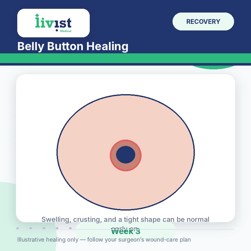 Belly button healing three weeks after tummy tuck