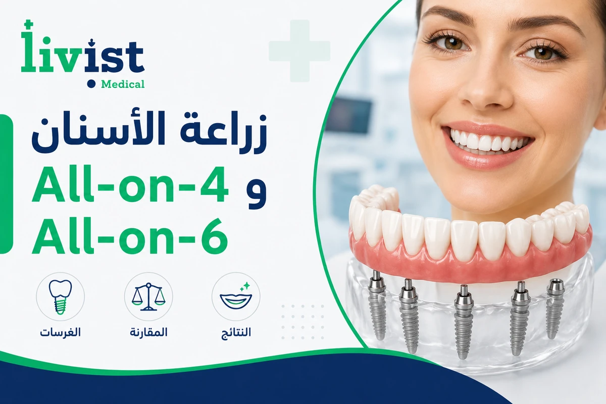 زراعة الأسنان All-on-4 وAll-on-6 في تركيا 2026: التكلفة والفرق