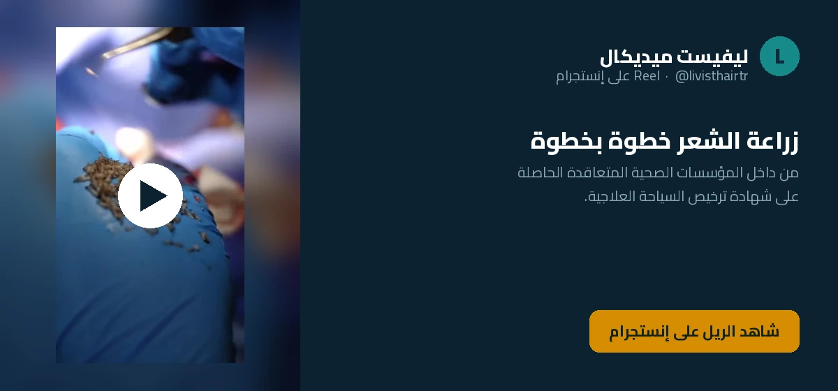 زراعة الشعر في مراحل الصلع المتقدّمة بالصور من حساب ليفيست