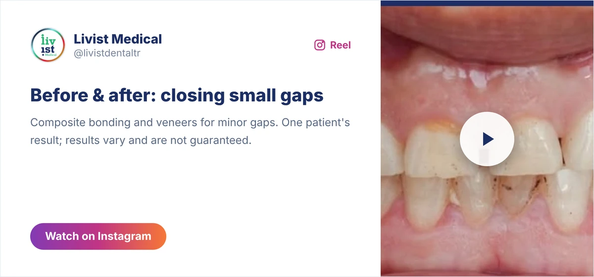 Instagram before and after card of tooth gaps closed with composite bonding and veneers from the Livist dental account