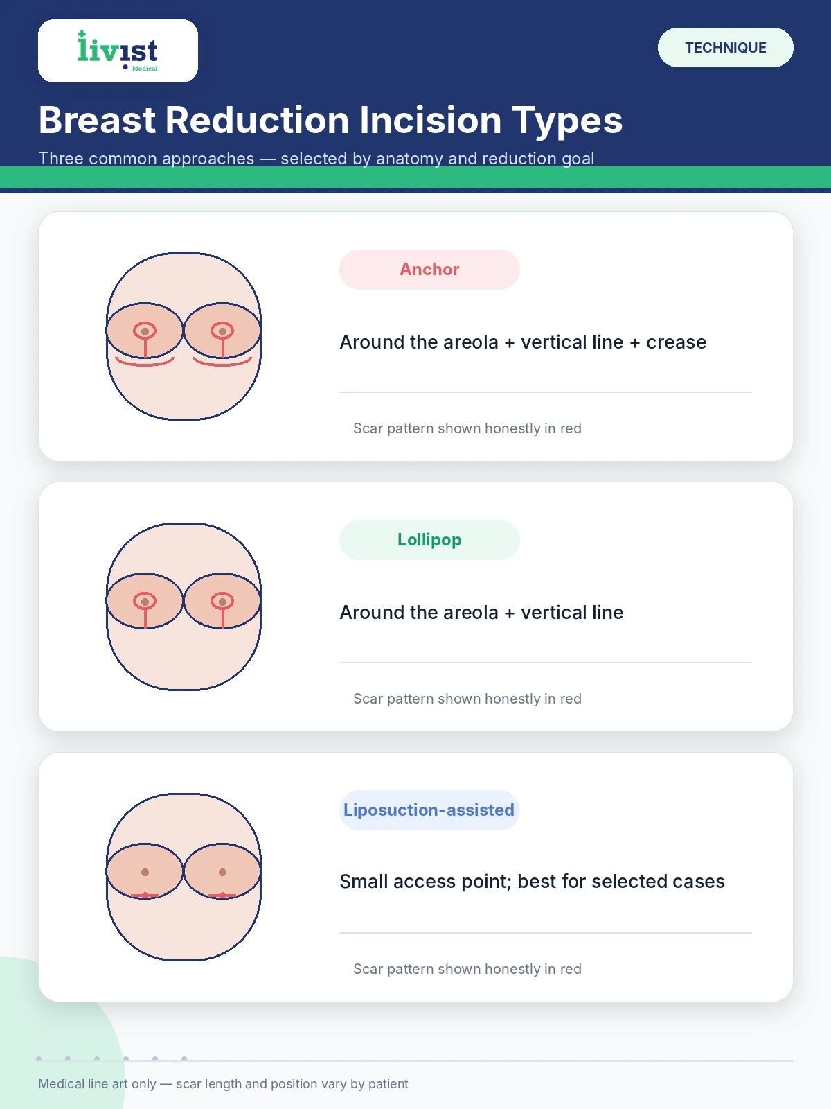 Anchor and lollipop incision types used in breast reduction