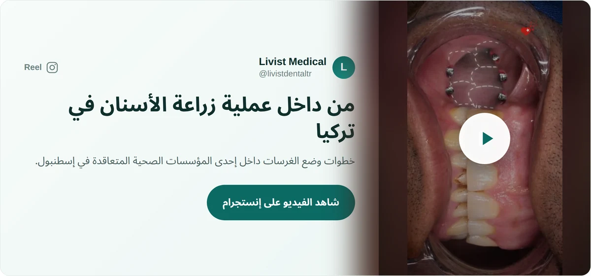 فيديو من داخل عملية زراعة الأسنان في تركيا مع ليفيست ميديكال