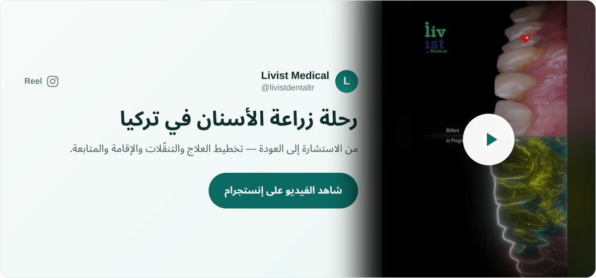 فيديو رحلة زراعة الأسنان في تركيا من الاستشارة إلى العودة مع ليفيست ميديكال