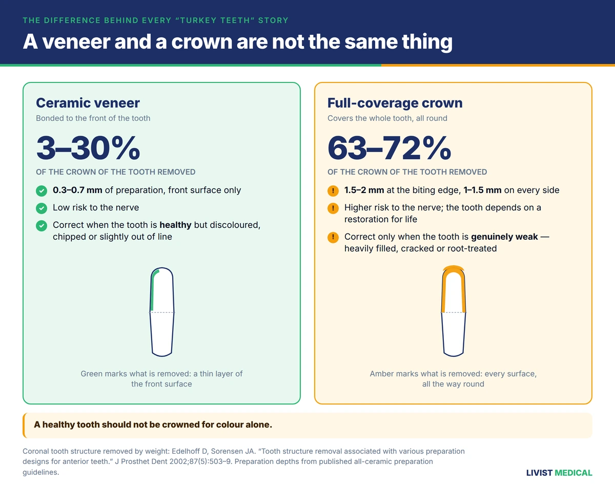 Veneer versus crown — how much enamel each removes