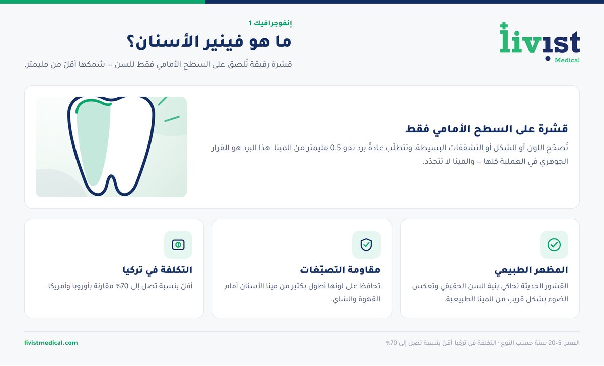 رسم توضيحي يشرح ما هو فينير الأسنان وكيف يُثبَّت على السطح الأمامي للسن