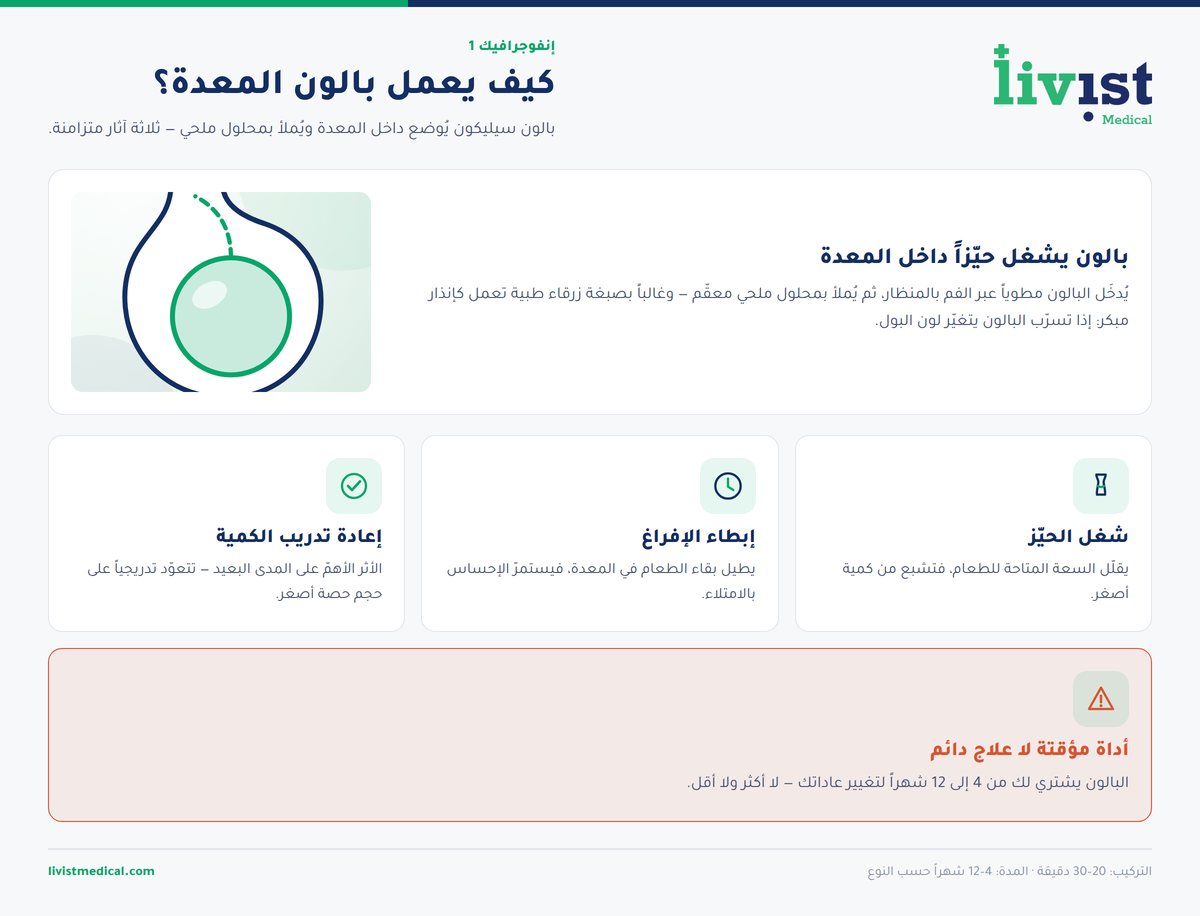 رسم توضيحي يشرح كيف يعمل بالون المعدة داخل المعدة وكيف يقلّل الكمية التي تستوعبها