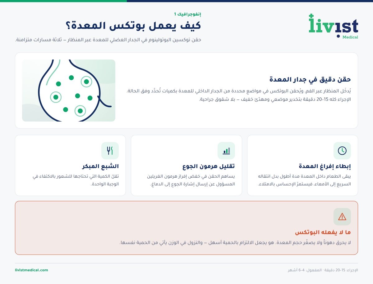 رسم توضيحي يشرح كيف يعمل بوتكس المعدة: مواضع حقن توكسين البوتولينوم في جدار المعدة وتأثيرها على سرعة إفراغ الطعام