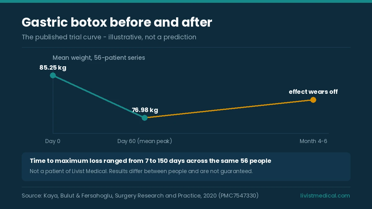 Gastric botox before and after: the published weight trajectory from 85.25 kg to 76.98 kg peaking near day 60