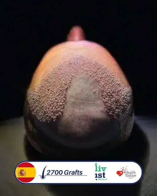 حالة زراعة شعر 2700 بصيلة في تركيا مع ليفيست ميديكال — مريض من إسبانيا