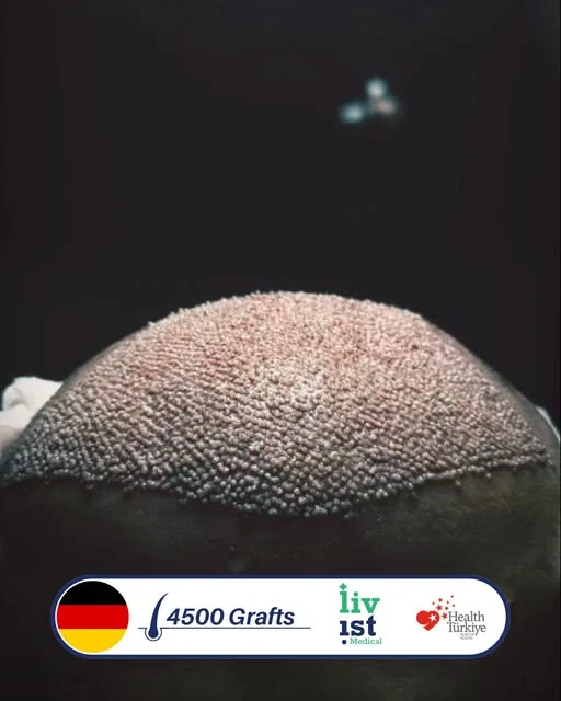 حالة زراعة شعر 4500 بصيلة في تركيا مع ليفيست ميديكال — مريض من ألمانيا