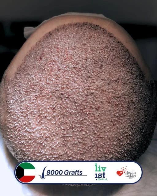 حالة زراعة شعر 8000 بصيلة في جلسة كبرى في تركيا مع ليفيست ميديكال — مريض من الكويت
