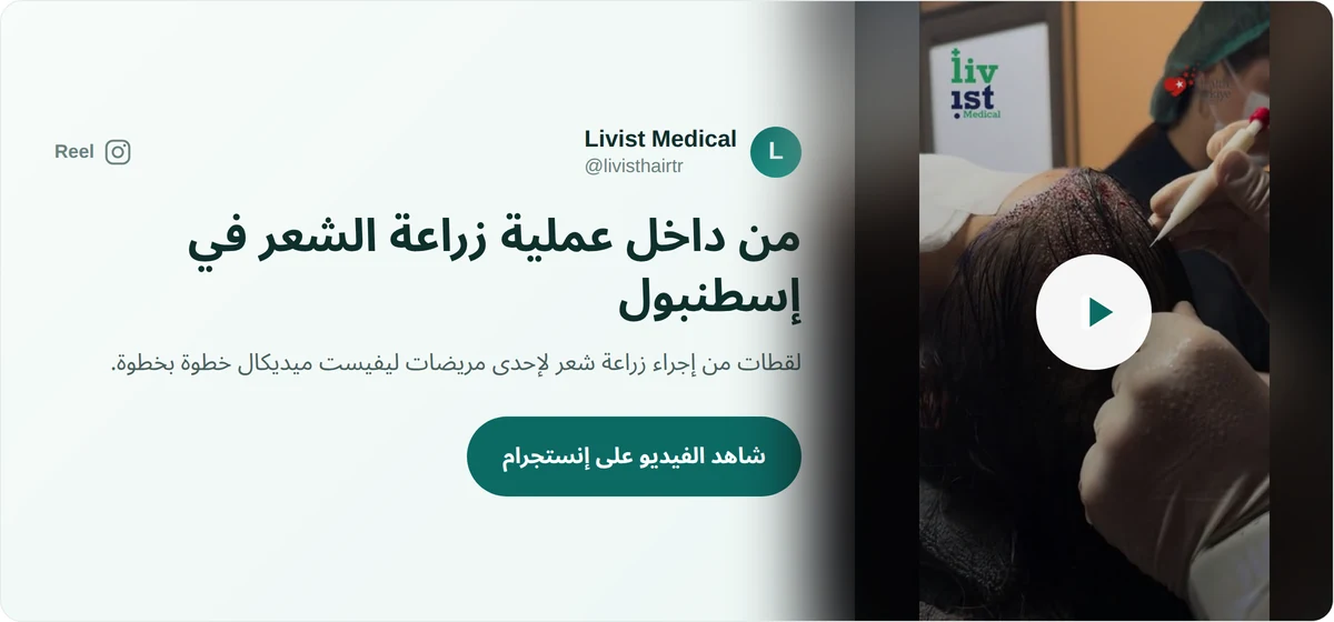فيديو من داخل عملية زراعة شعر في مؤسسة صحية متعاقدة في إسطنبول