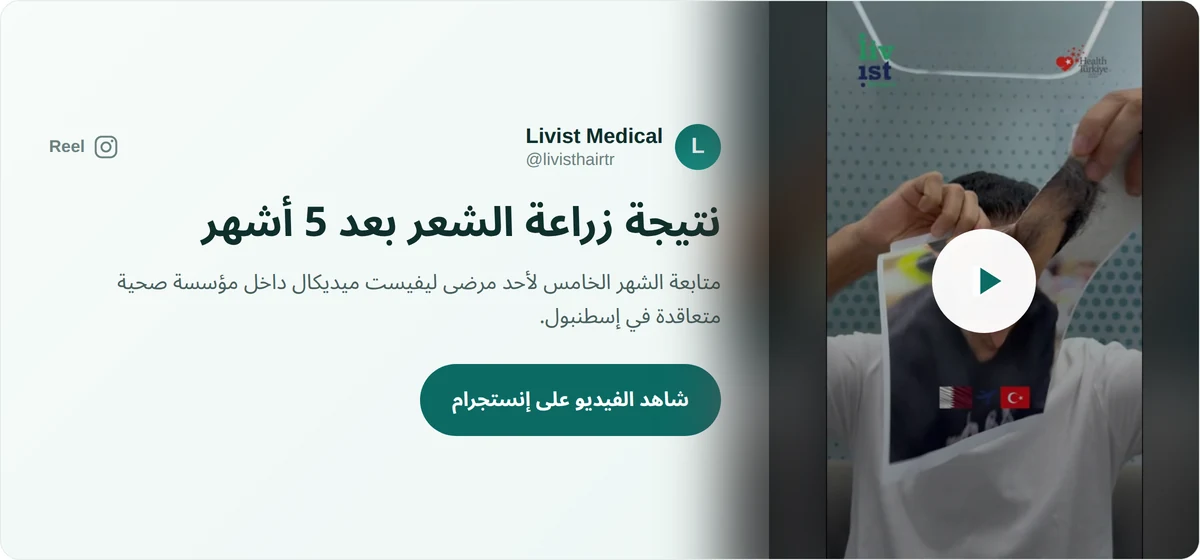 فيديو نتيجة زراعة الشعر في تركيا بعد 5 أشهر لأحد مرضى ليفيست ميديكال