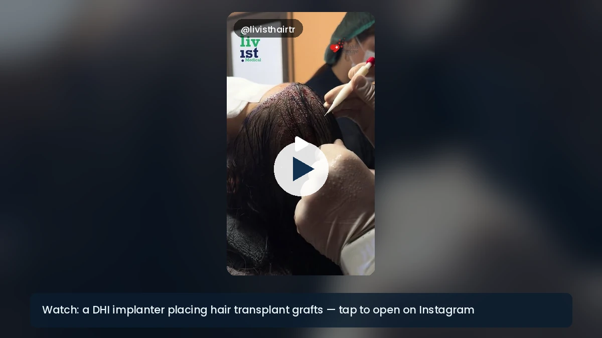 DHI hair transplant implanter pen placing grafts in the recipient area