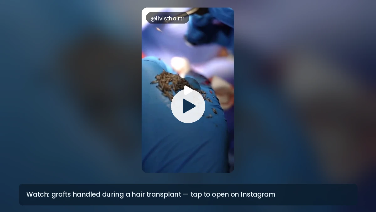 Hair transplant grafts handled in a sterile clinical setting