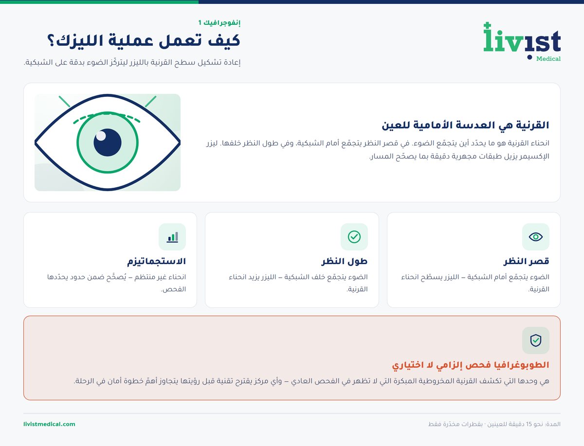 رسم توضيحي لمقطع العين يشرح خطوات عملية الليزك وإعادة تشكيل القرنية بالليزر