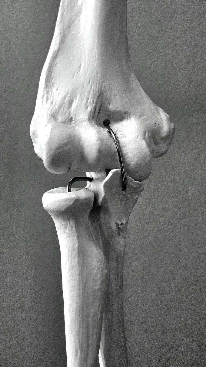 Anatomical model of the knee and leg bone with a metal rod