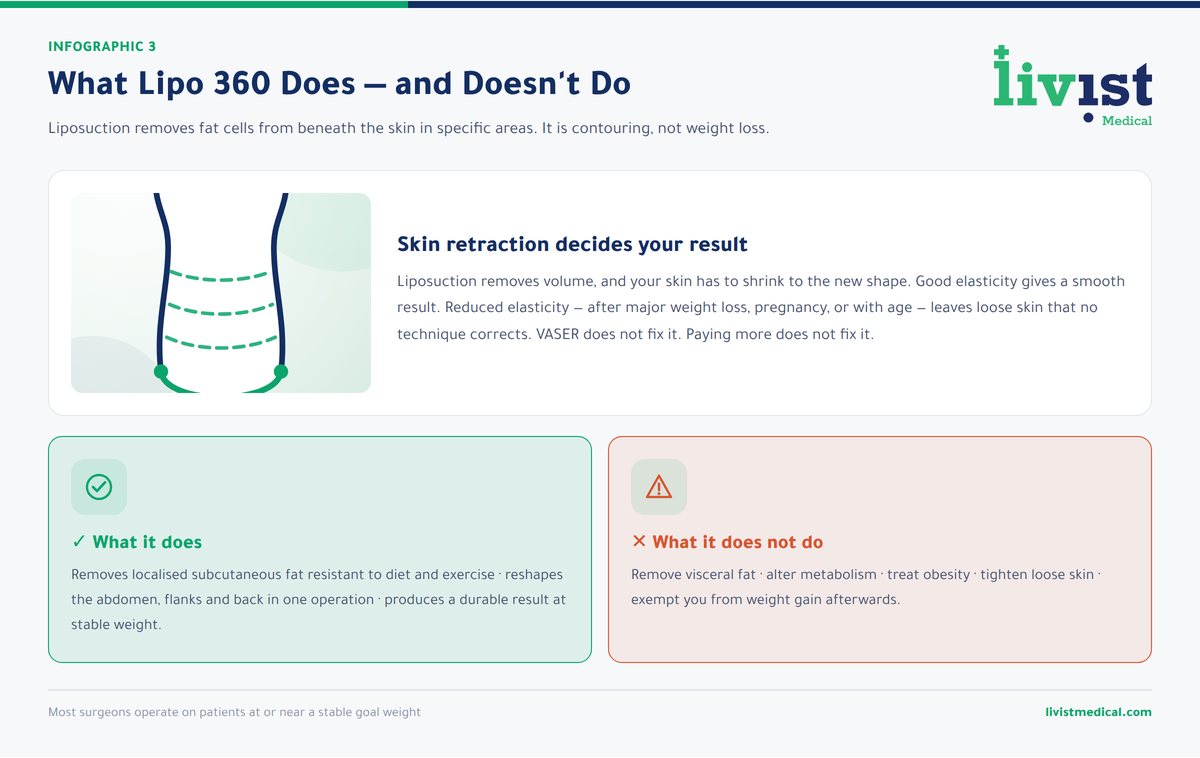 What Lipo 360 does and does not do — contouring versus weight loss and skin tightening
