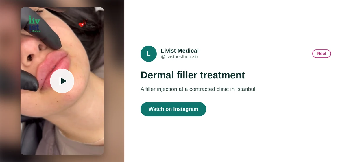 Livist Aesthetics Instagram reel card showing a dermal filler injection treatment