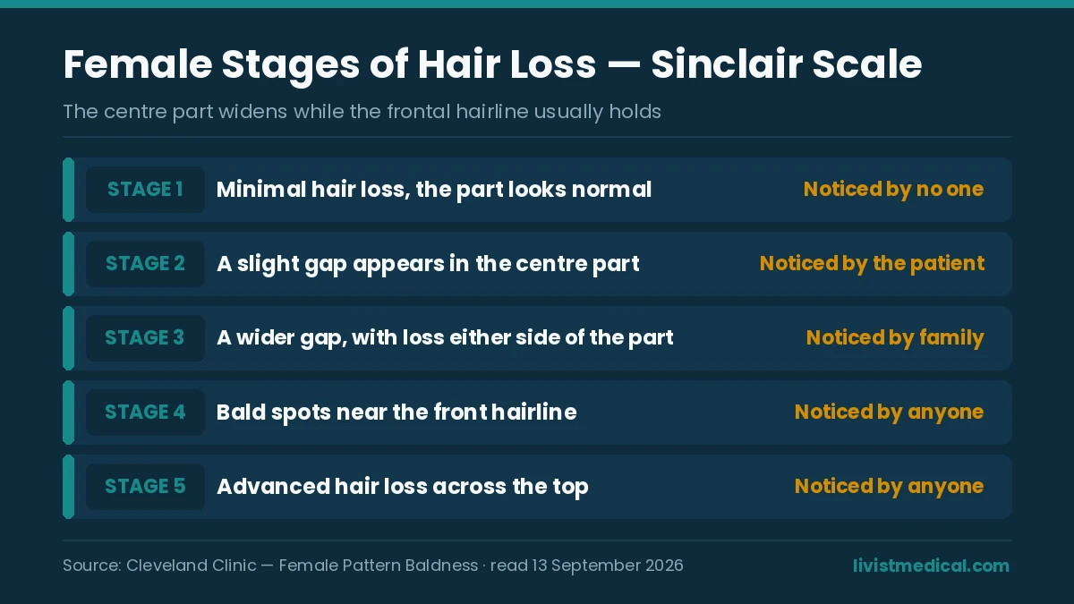 The five Sinclair stages of hair loss in women