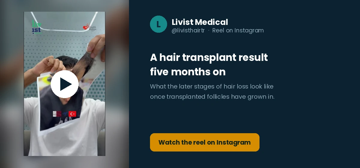 A hair transplant result five months on at the later stages of hair loss