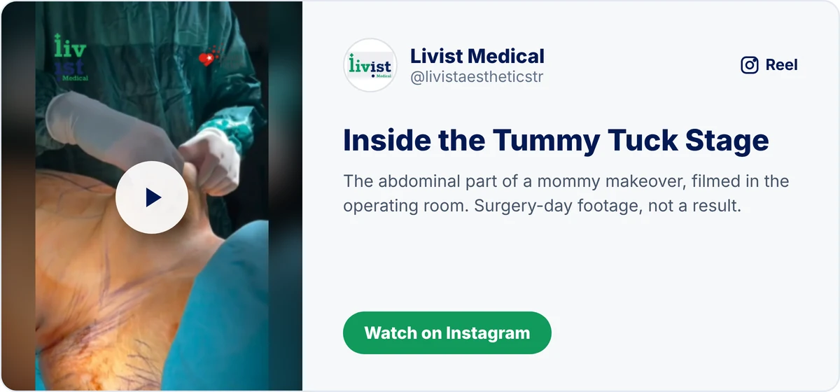 What is a mommy makeover video: the tummy tuck stage in the operating room