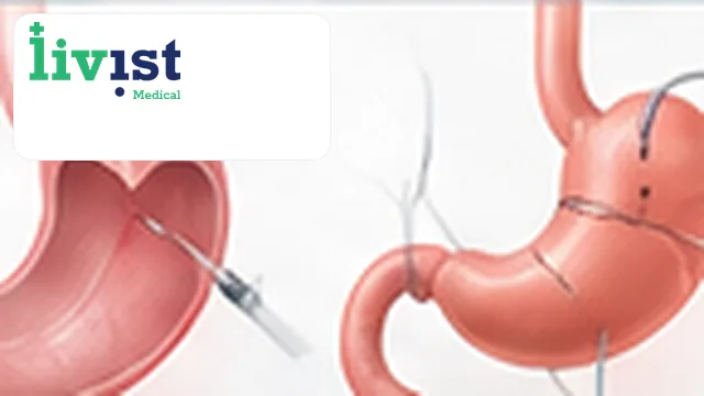 Adjustable Gastric Band