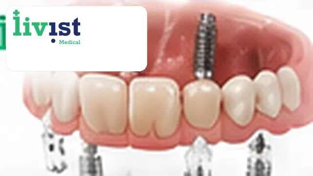 All-on-4 Dental Implants (Straumann) Turkey All-Inclusive Package