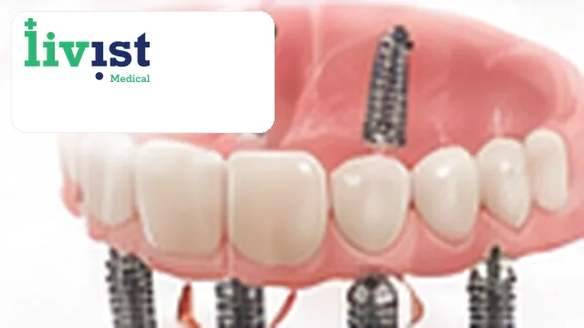 All-on-4 Dental Implants (BEGO) Turkey All-Inclusive Package – Full Mouth