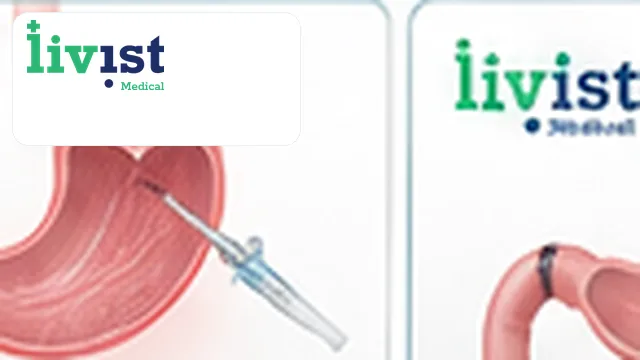Gastric Botox Injection