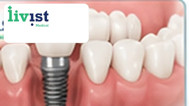 Dental Implant (BEGO) Turkey All-Inclusive Package – Single Tooth