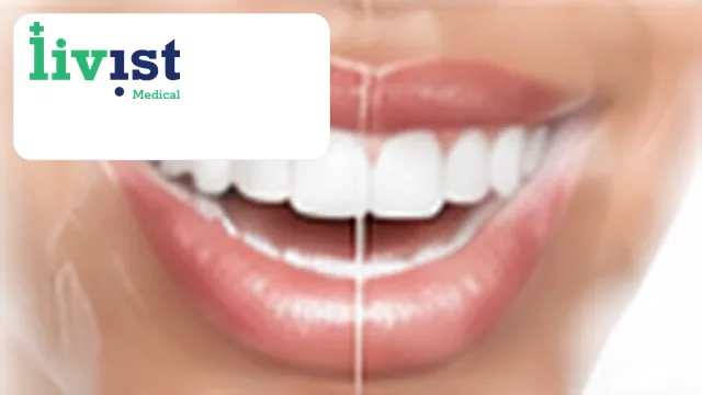 Hollywood Smile (16 Emax Veneers) Turkey All-Inclusive Package