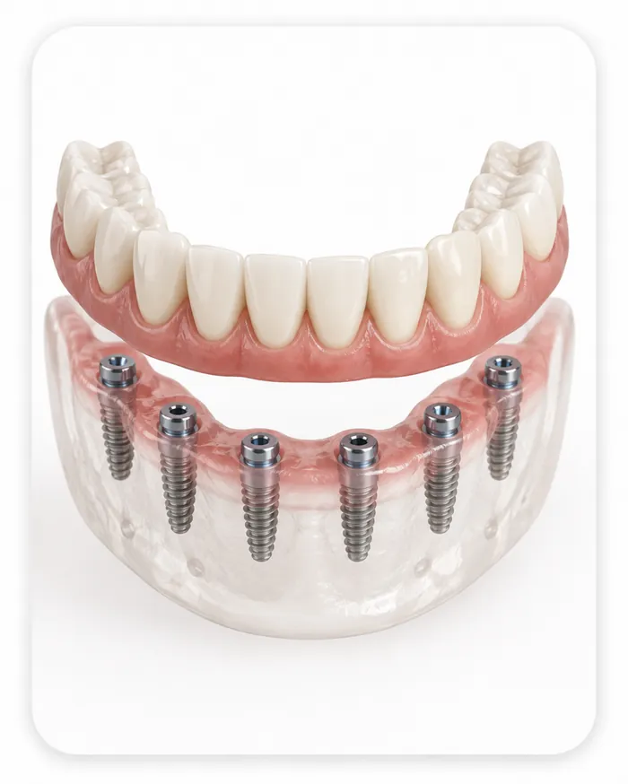All-on-6 Dental Implants