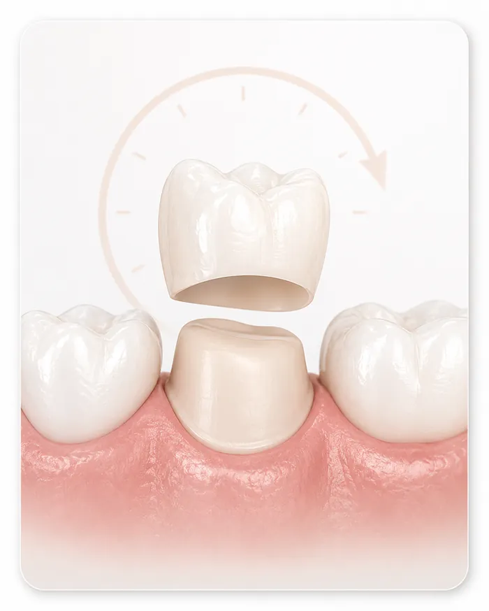 CEREC Same-Day Crowns